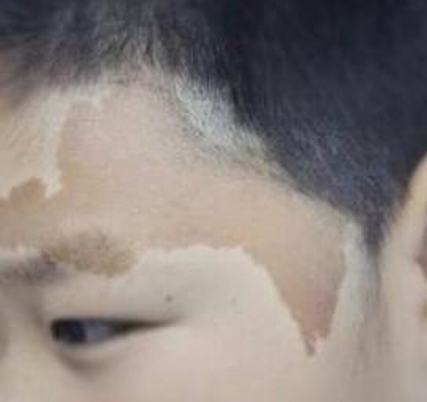 咖啡斑如何治疗