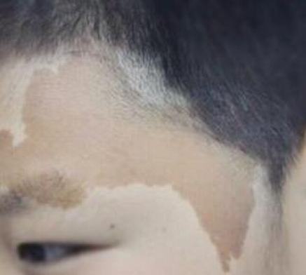 咖啡斑治疗的病因及措施