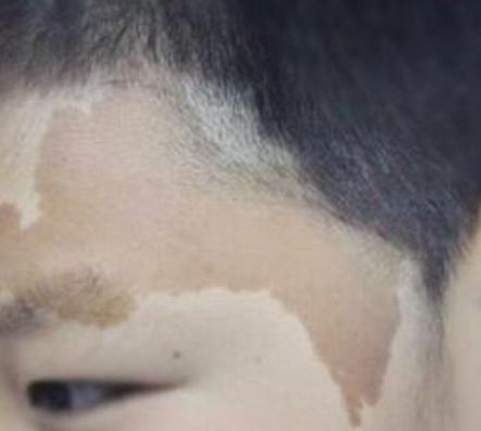 咖啡牛奶斑应怎样诊治好呢