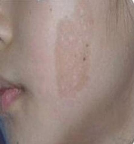 脸颊咖啡斑是否会传染呢