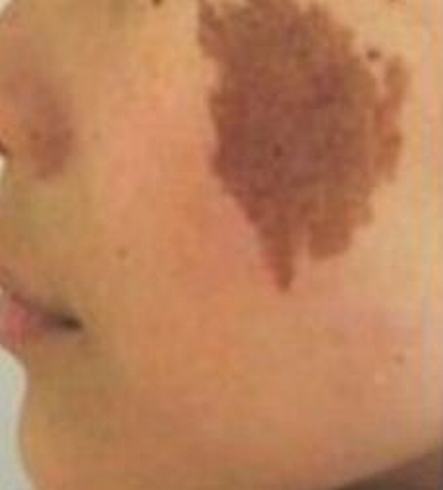 脸上的咖啡斑会逐渐消失吗