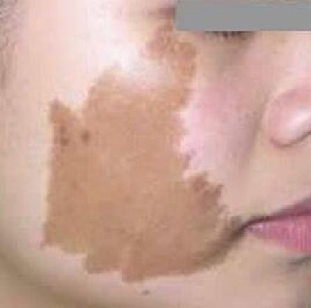 皮肤病咖啡斑症状有什么