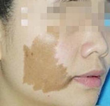 激光除掉面部咖啡斑后应注意哪些