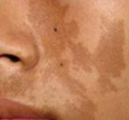 激光去咖啡斑应注意哪些