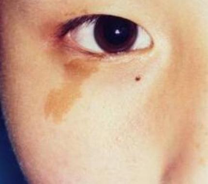 激光去咖啡斑有什么要注意的