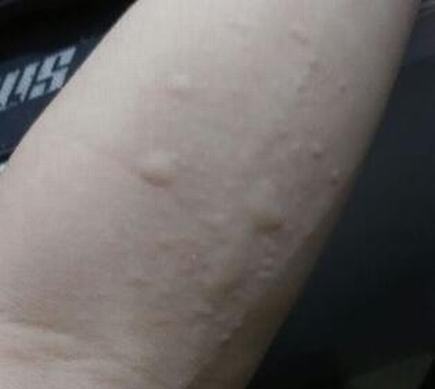 皮肤瘙痒可能是是多种疾病的信号