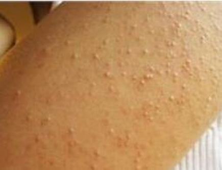 皮肤瘙痒期疙瘩的原因是什么