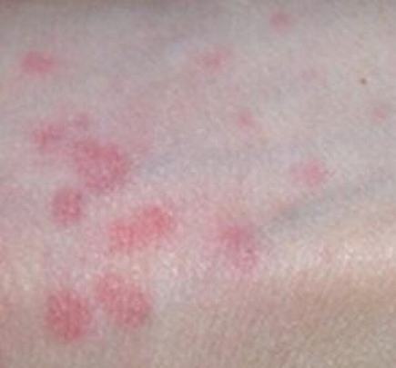 皮肤瘙痒是种什么病