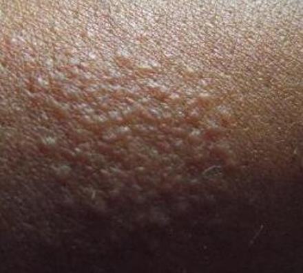 皮肤瘙痒症患什么病