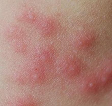 皮肤瘙痒症是秋季较多见的皮肤疾病之一