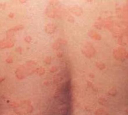 皮肤瘙痒症在秋季的诊治