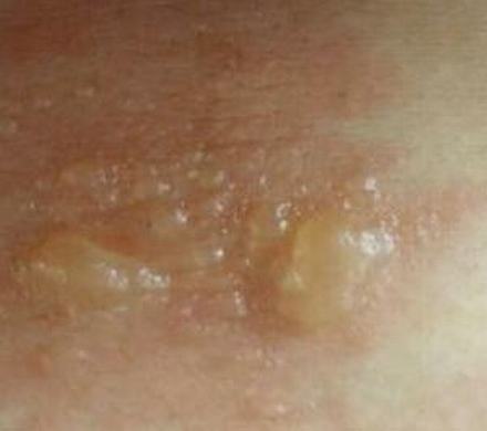 皮肤瘙痒症治疗时的几个特别注意
