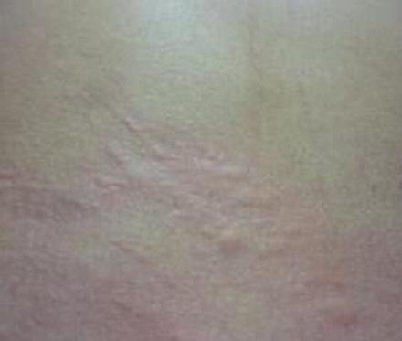 皮肤瘙痒治疗上的误区有什么
