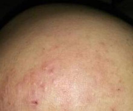 皮肤瘙痒抓后起小红疹怎么办