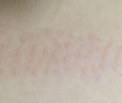 缓解皮肤瘙痒的生活小妙招