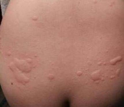 你知道皮肤瘙痒症患什么病吗
