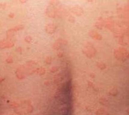 皮肤瘙痒的病理病因