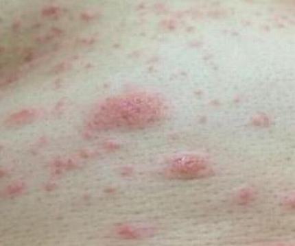 皮肤瘙痒的原因及治疗