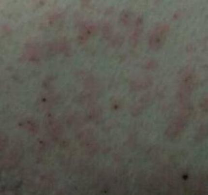 皮肤瘙痒的原因与治疗