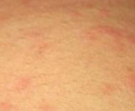 皮肤瘙痒的症状是什么