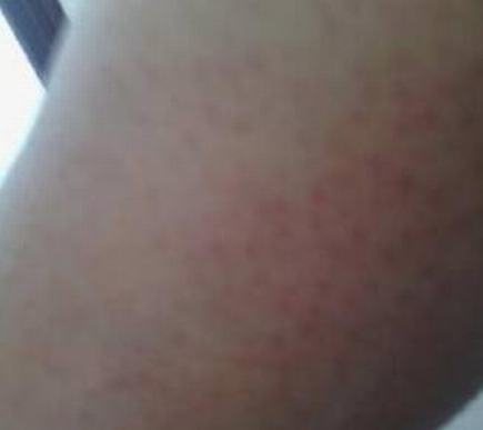 男性的阴囊潮湿瘙痒是什么情况