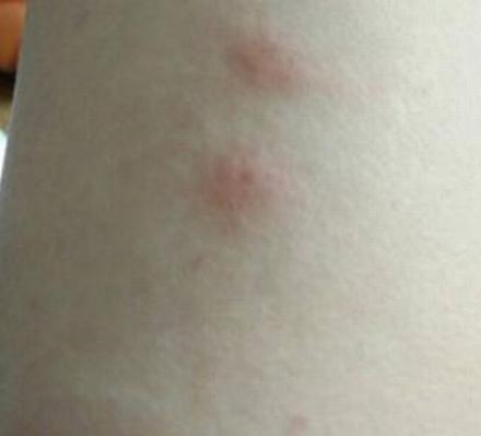 瘙痒背后会导致哪些疾病