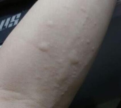 对付瘙痒症 如何选用药膳