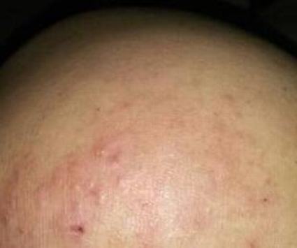肛门瘙痒的注意什么事情