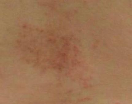 肛门瘙痒症状