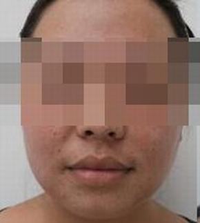 女人雀斑的原因是哪些
