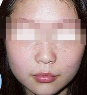 女性五个年龄段易长斑消灭雀斑只需七步走