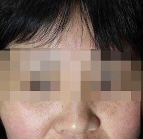 去雀斑的有效措施