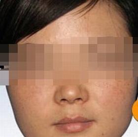 去雀斑都有什么方法呢