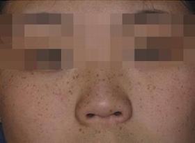 容易和雀斑混淆的疾病有哪些