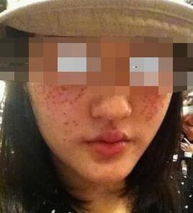 如何治疗雀斑效果好