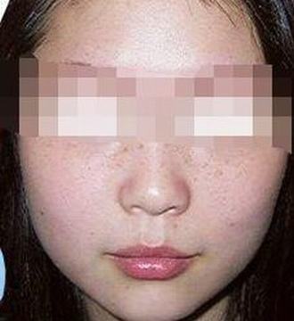 做个零斑点的美女