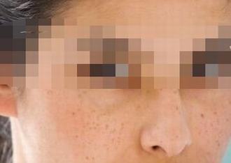 脸上雀斑形成的原因是什么