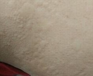 青岛百姓皮肤病医院医生解释生活中荨麻疹的预防