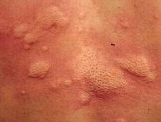荨麻疹的危害具体有哪些表现