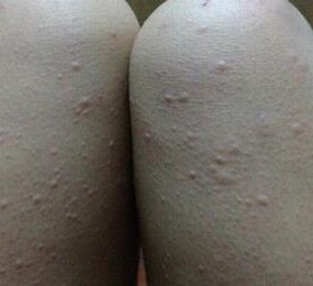 荨麻疹是生活中常发生的一种皮肤病,当宝宝接触过敏原时,可在身体