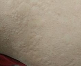 宝宝患上荨麻疹有什么损害
