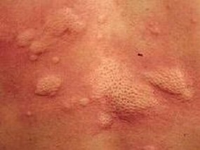 背部荨麻疹如何防止