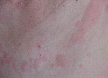 诱发人工荨麻疹的病因