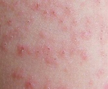 引起荨麻疹的原因是什么