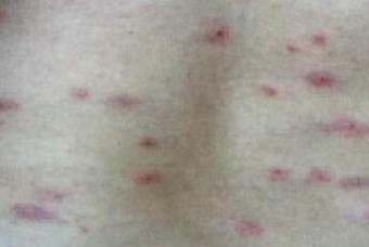 青岛百姓皮肤病医院医生详谈大腿内侧荨麻疹