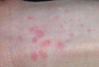 青岛百姓皮肤病医院医生科学解析荨麻疹的危害