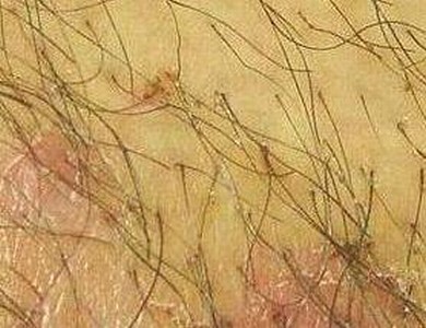 阴虱病治疗有哪些需注意