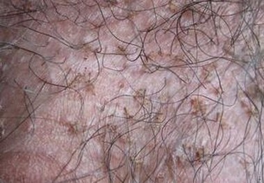 阴虱病应如何治疗