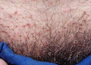 阴虱病什么症状
