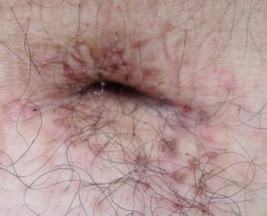 阴虱病会引起哪些症状